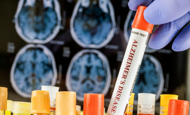 Organoidi cerebrali per la ricerca sull'Alzheimer